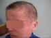atopic_dermatitis_0.jpg