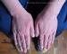 ����������� �������� (atopic_dermatitis)