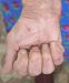 Dermatitis herpetiformis Duhring