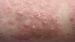 Dermatitis herpetiformis Duhring