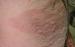 Erythema anulare
