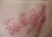 ����� ������������, ������, herpes zoster