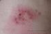 ����� ������������, ������, herpes zoster