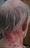 herpes_zoster_2.jpg