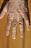 herpes_zoster_1.JPG