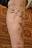 kaposis_sarcoma_2.jpg