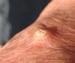Keratoacanthoma