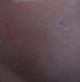 lichen_sclerosus_et_atrophicus.jpg