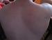 lichen_sclerosus_et_atrophicus1.jpg