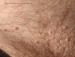 ������������ ������� (molluscum contagiosum)