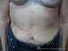 Neurofibromatosis Recklinghausen