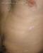 Sutton's nevus ����� �������, ���������