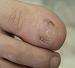 ���������� - onychomycosis