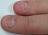 o����������, onychophagia, ����������� ������