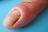 ���������, paronychia