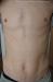 ����� ������� ������ (pityriasis rosea)