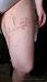 ����������� ������� (porokeratosis Mibelli)