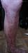 ����������� ������� (porokeratosis Mibelli