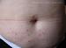 ������� - scabies