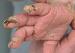 ������� - scabies