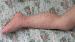 ���������� ������� - scabies norvegica
