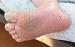 Scabies