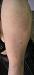 �������� ������������ - sclerodermia