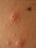 varicella