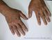 �������� (vitiligo)