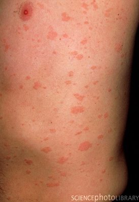 ������� ����� ������ - Pityriasis rosea