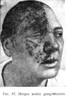 Herpes zoster