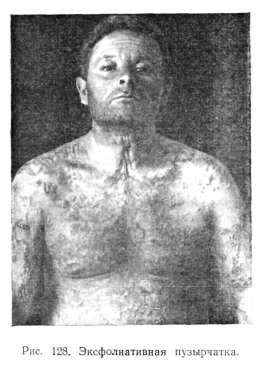 �������������� (�����������) ���������� (PEMPHIGUS FOLIACEUS)