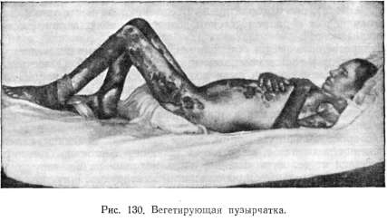 Pemphigus vegetans