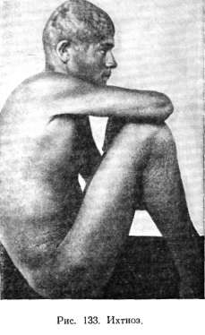 ������ (ichthyosis)