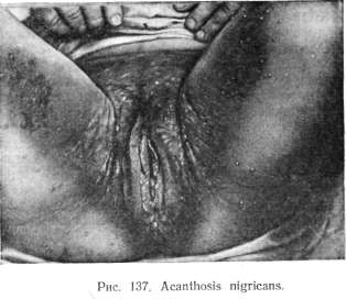 Acantosis_nigricans