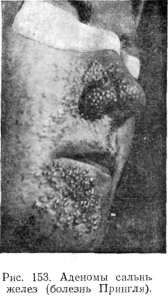 ������� (adenoma)