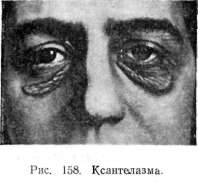 ����������� (xanthelasma)