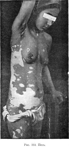 Vitiligo (��������)