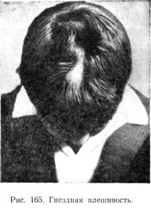 Alopecia areata (�������� ��������)