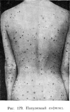 ���������� ������� (syphilis papulosa)