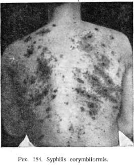 ���������� ������� (syphilis papulosa)