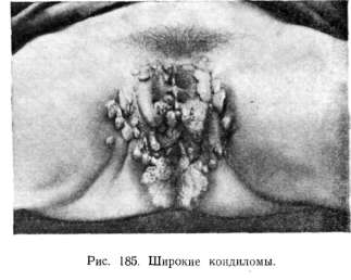 ���������� ������� (syphilis papulosa)