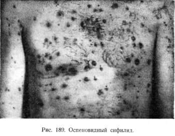 ����������� ������� (syphilis pustulosa, pustulae syphiliticae)