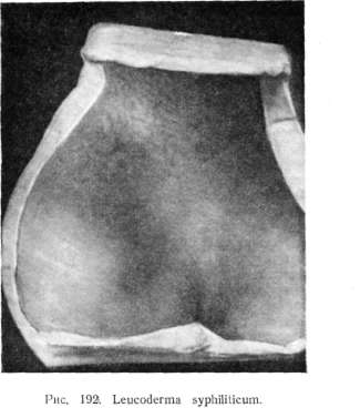 ���������� ������� (leucoderma syphiliticum)