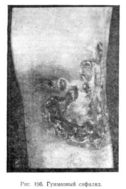 ��������� ������� (syphilis gummosa)