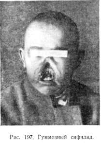 ��������� ������� (syphilis gummosa)