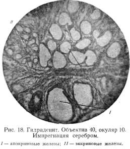 Hydradenitis