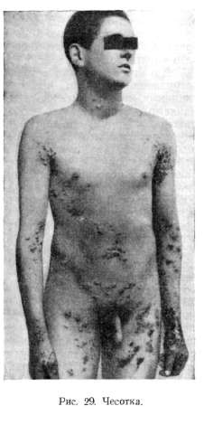 Scabies, �������