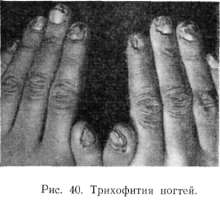 ���������� ������, onychomycosis trichophytica.
