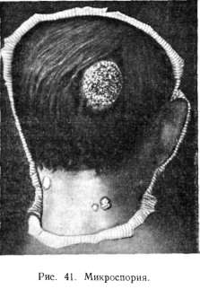 ����������� ���������� ����� ������. Microsporia